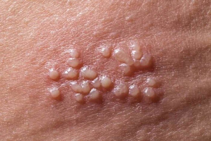 چه زمانی واکسن اچ پی وی بزنیم؟