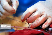 جراحی دریچه آئورت« کم تهاجمی» برای نخستین بار در مازندران