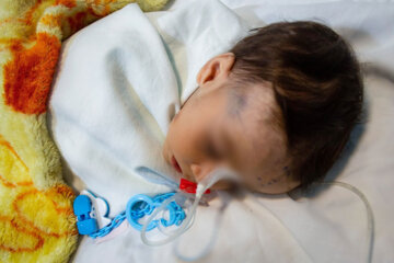  کودکان مبتلا به امیکرون در بیمارستان آیت الله طالقانی گرگان