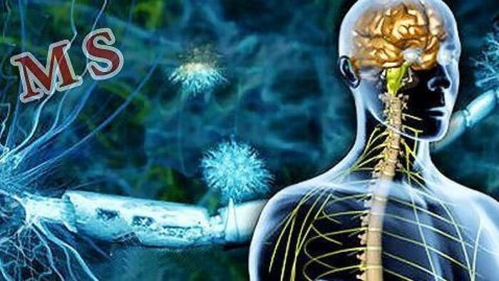 زندگی با ام.اس؛ چالش ها و امیدها + فیلم