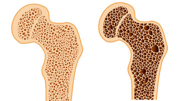 حدود ۵۰ درصد افراد مبتلا به پوکی استخوان دچار شکستگی لگن می‌شوند