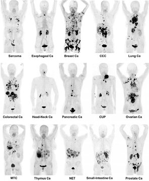 تشخیص ۳۰ نوع سرطان با ردگیر رادیواکتیو جدید
