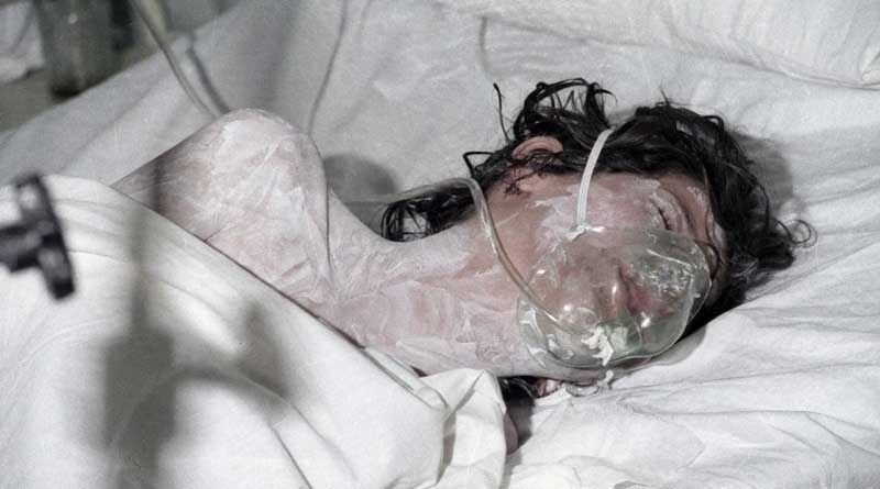 Sardasht: First victim of chemical attack in world