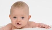 وراثت و بیماری‌های ویروسی از عوامل ابتلا به شکاف لب و کام در نوزادان
