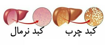 نیمی از بیماران کبدچرب با رژیم غذایی مناسب و ورزش درمان می‌شوند