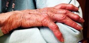 عامل درد بیماران مبتلا به آرتروز شناسایی شد