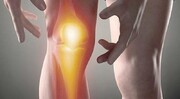 بیشترین آرتروز در مفصل زانو رخ می‌دهد