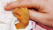 قراردادن نوزادان مبتلا به زردی زیر نور مهتابی معمولی درمان کننده نیست