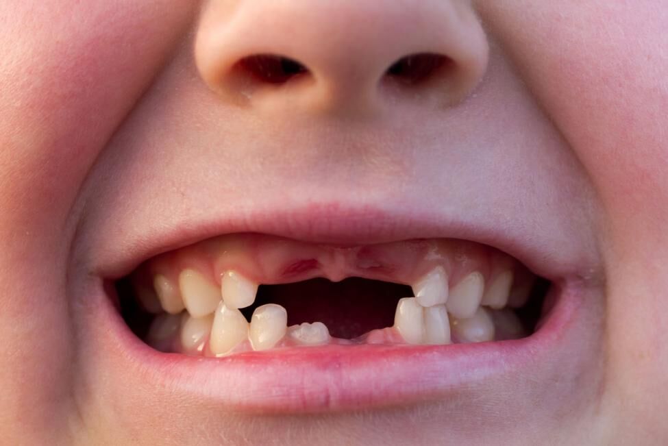 آنتی بیوتیک برای بسیاری از موارد درد دندان ضروری نیست