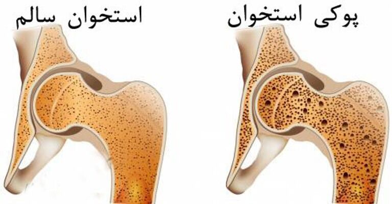 مهار پوکی استخوان با تشخیص به موقع - ایرنا