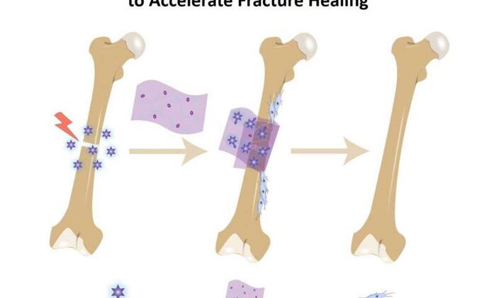 ساخت بانداژ جدید برای ترمیم سریع‌تر استخوان