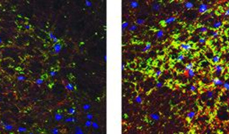 درمان آسیب نخاعی با داروی سکته مغزی