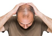 درمان سریع ریزش مو، کذب محض است