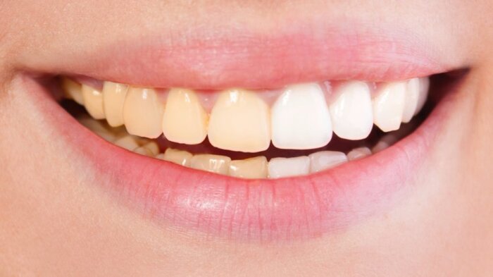 عادت‌های غلطی که باعث تغییر رنگ دندان‌ها می‌شوند