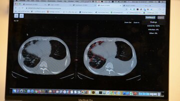 عرضه رایگان سامانه هوشمند ایرانی تشخیص کووید۱۹ به جهان