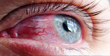 التهاب چشم یکی از نشانه‌های تهاجم کرونا است