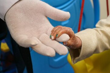 L'UNICEF envoie en Iran des pansements pour les enfants atteints d'épidermolyse bulleuse