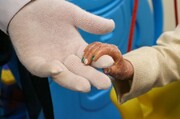 UNICEF schickt Verbände für Kinder mit Epidermolysis bullosa in den Iran