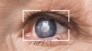 ضرورت استفاده از لنزهای مختلف پس از عمل جراحی آب مروارید 