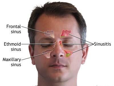 پیشگیری از سینوزیت به کمک یک باکتری بینی