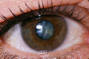 ۲۰ درصد تیروئیدی‌ها مبتلا به علایم چشمی هستند