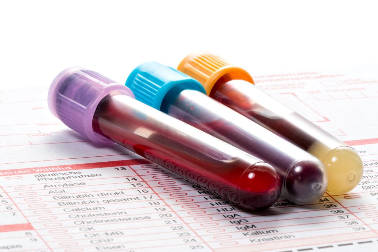 تشخیص سکته‌های خفیف با آزمایش خون