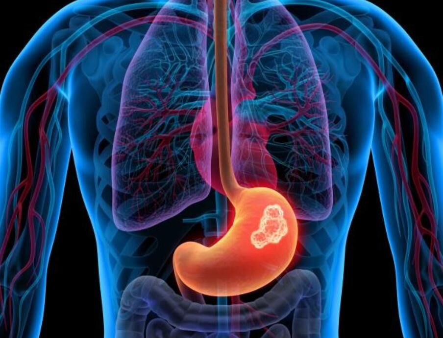  علائم و درمان سرطان معده چیست؟