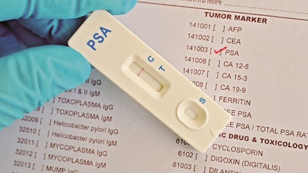 ابداع یک آزمایش جدید ادرار برای تشخیص سرطان پروستات