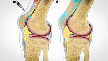 تولید نانو روان‌کننده‌های زیستی از نشاسته ذرت برای بیماری‌های مفاصل