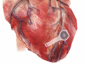ابداع ضربان ساز قلب که در بدن جذب می‌شود