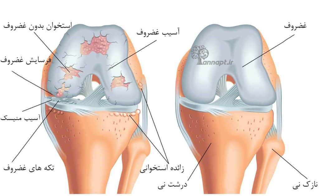 افزایش وزن و کم تحرکی آرتروز زانو را تسریع می‌کند