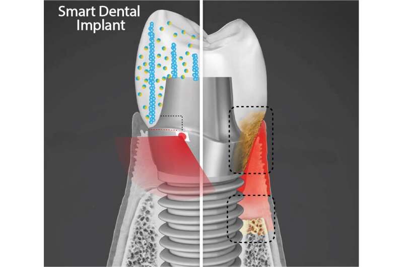 ایمپلنت هوشمند مانع رشد باکتری روی دندان‌ها می‌شود