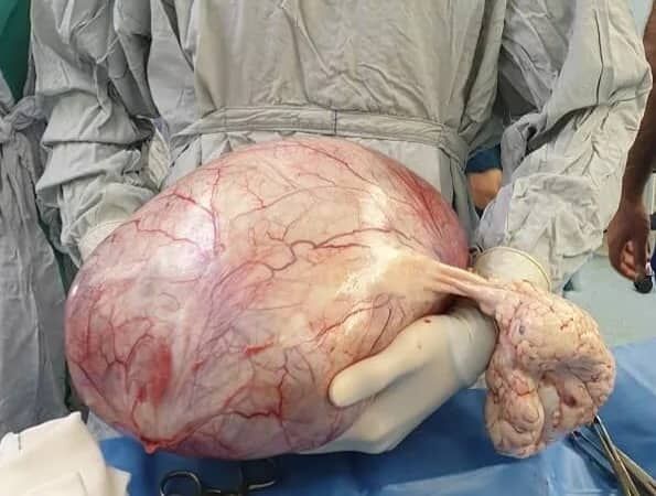 تومور ۸.۵ کیلوگرمی با موفقیت از تخمدان یک زن در یزد خارج شد