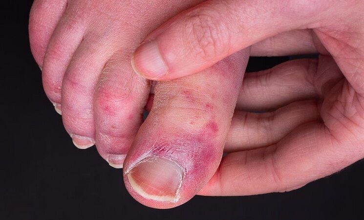 یافته‌های جدید محققان در مورد پدیده "انگشت کووید"