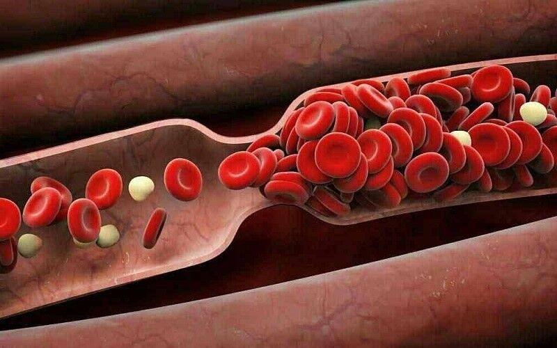 فیلم: غلظت خون در افراد ۶۰ تا ۶۵ سال رایج است
