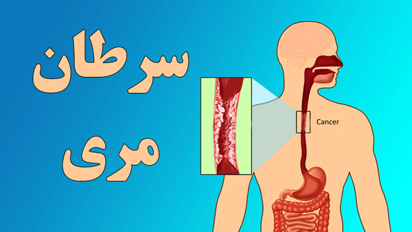 هیچ سرنخی از عامل «الگوی ژنتیکی» در بروز سرطان مری یافت نشده است