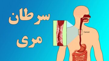 هیچ سرنخی از عامل «الگوی ژنتیکی» در بروز سرطان مری یافت نشده است