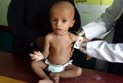 سازمان جهانی بهداشت: ۷۵ درصد از کودکان یمن از سوء تغذیه رنج می‌برند