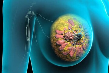 فیلم | هشدار افزایش بیماری سرطان پستان در مازندران