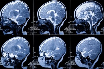 شناسایی زودهنگام سرطان‌ مغز و پروستات با MRI نانویی