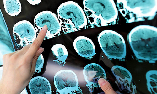 ام اس، محصول استرس و تغییر سبک زندگی