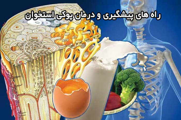 پوکی استخوان؛ اپیدمی پنهان دنیای امروز