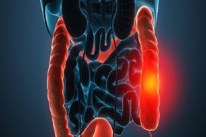 عادیانگاری سرطان یا آتش زیرخاکستر