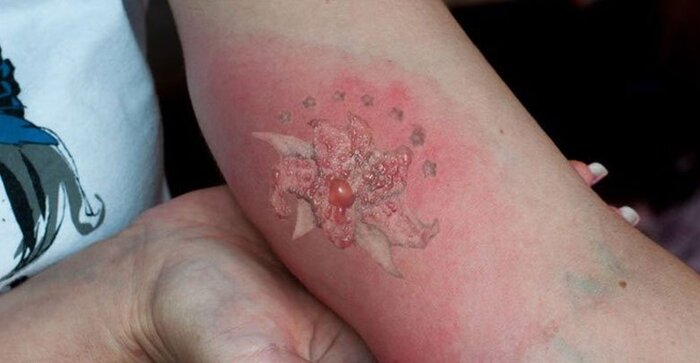 تَتو؛ مُد یا معضل/زیبایی و زخمی که روی پوست میماند