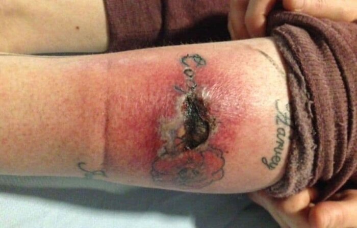 تَتو؛ مُد یا معضل/زیبایی و زخمی که روی پوست می‌ماند