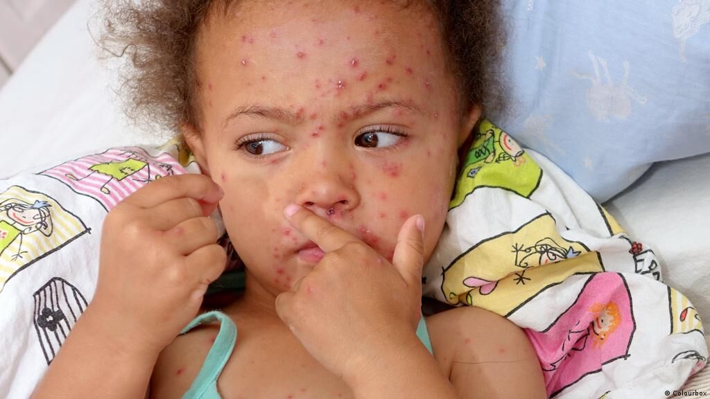 ۵ هزارو ۵۰۰ کودک افغان به سرخک مبتلا شدند 