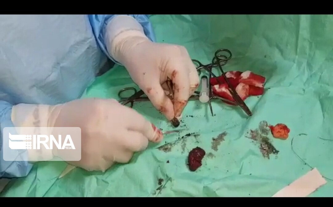 گلوله تفنگ پس از ۳۸ سال از بدن جانباز جهرمی بیرون آورده شد  گلوله تفنگ پس از ۳۸ سال از بدن جانباز جهرمی بیرون آورده شد