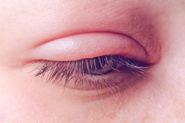 مبتلایان به پسوریازیس چگونه از چشم خود محافظت کنند