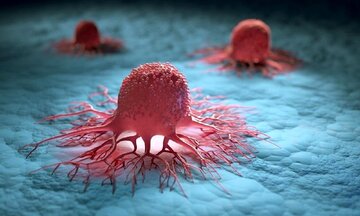 تشخیص زودهنگام؛ راه طلایی پیشگیری از سرطان پستان