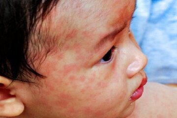 تاکنون موردی از ابتلا به سرخک در کرمانشاه گزارش نشده است
